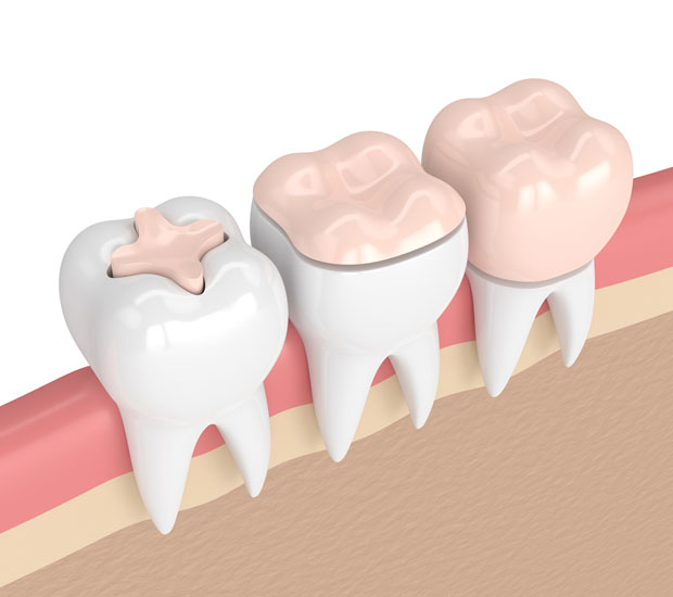 Brentwood Dental Inlays and Onlays
